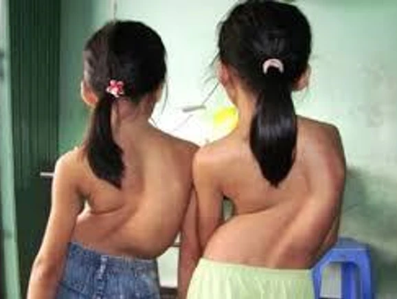 BÀI TUYÊN TRUYỀN BỆNH CONG VẸO CỘT SỐNG Ở HỌC SINH
