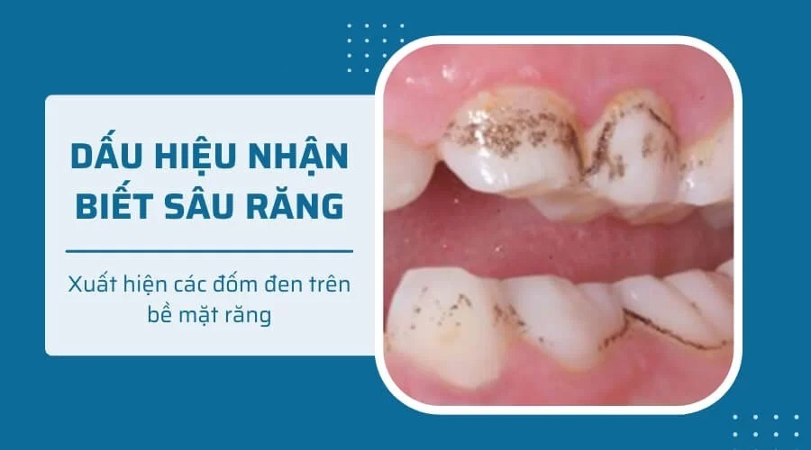 Dấu hiệu nhận biết sâu răng sơm
