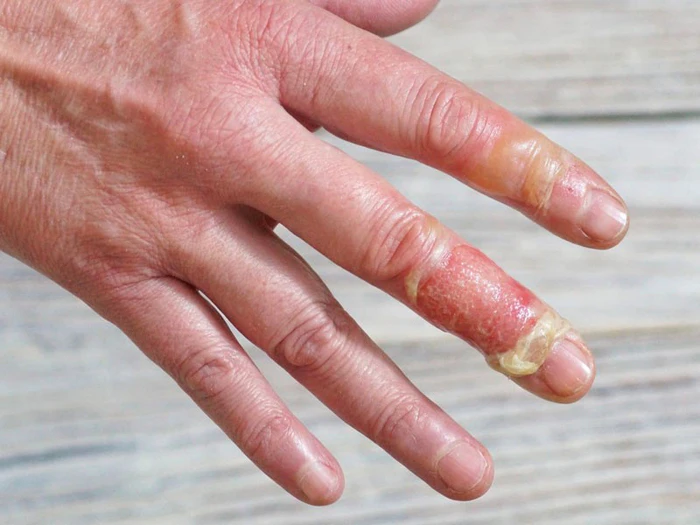 Những điều nên tránh khi xử lý vết bỏng phồng nước