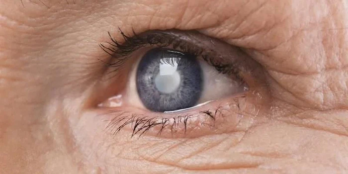Dấu hiệu lão hoá mắt ở người trung niên – mắt mờ, khô, nhạy sáng