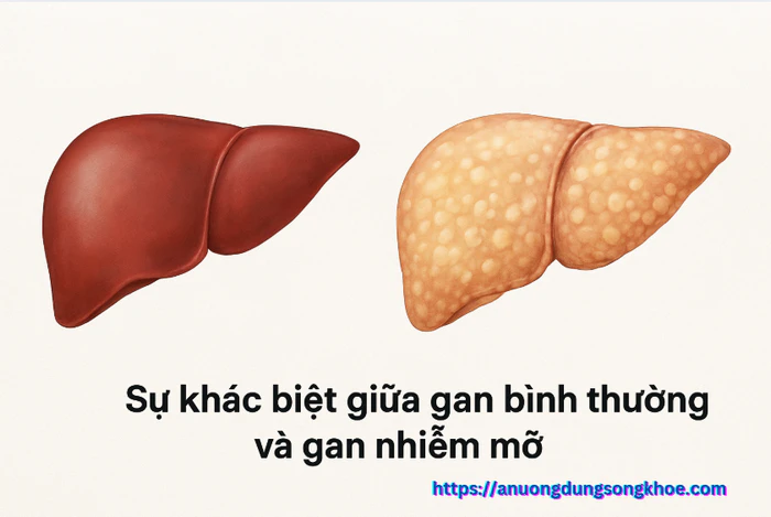 Gan nhiễm mỡ kiêng gì? Danh sách thực phẩm cần tránh để gan phục hồi nhanh nhất