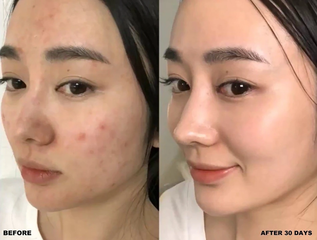 kết quả cách trị mụn tại nhà hiệu quả