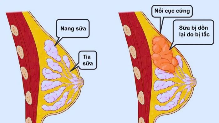 Những Lưu Ý Quan Trọng Khi Điều Trị Tắc Sữa