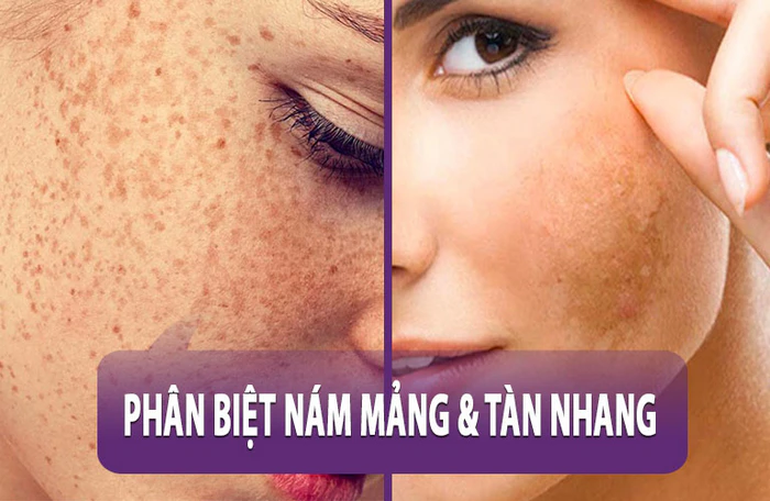 Phân biệt nám và tàn nhang qua hình ảnh thực tế trên da mặt