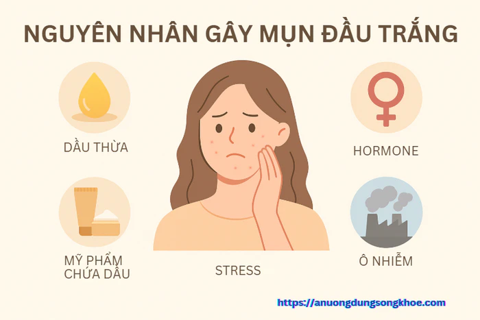 Nguyên nhân gây mụn đầu trắng – infographic minh họa các yếu tố gây bít tắc lỗ chân lông