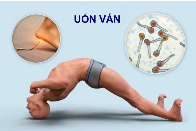 triệu chứng bệnh uốn ván